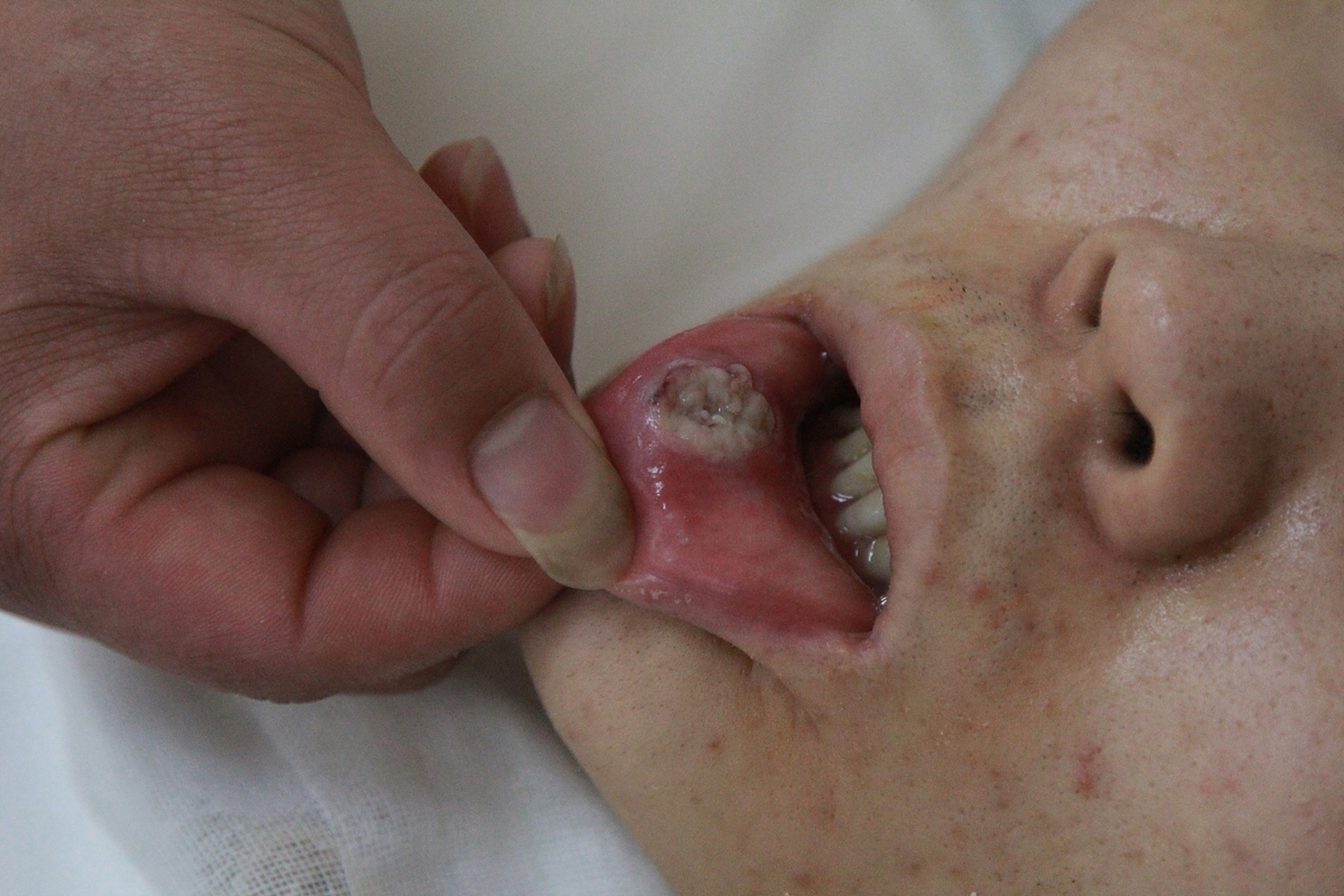 尖锐湿疣怎么治疗才能根治口腔_(尖锐湿疣怎么治疗才能根治口腔溃疡)  第2张