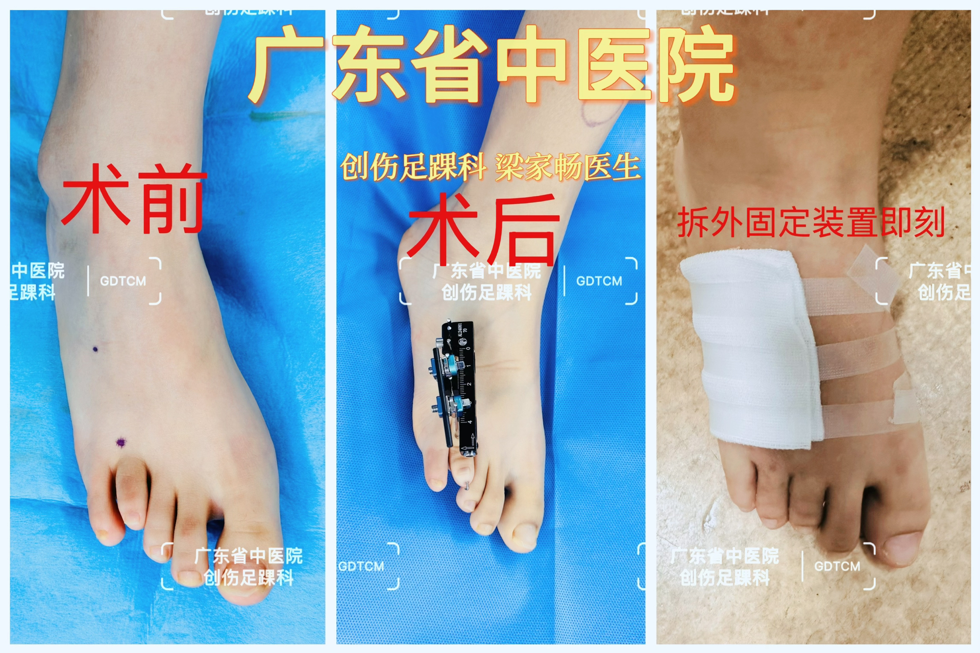 穆西亚拉腓骨骨折手术成功开始进入恢复阶段的简单介绍  第2张